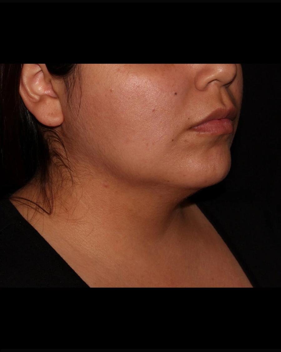 Buccal Fat Pad Removal, Oblique Right view, before