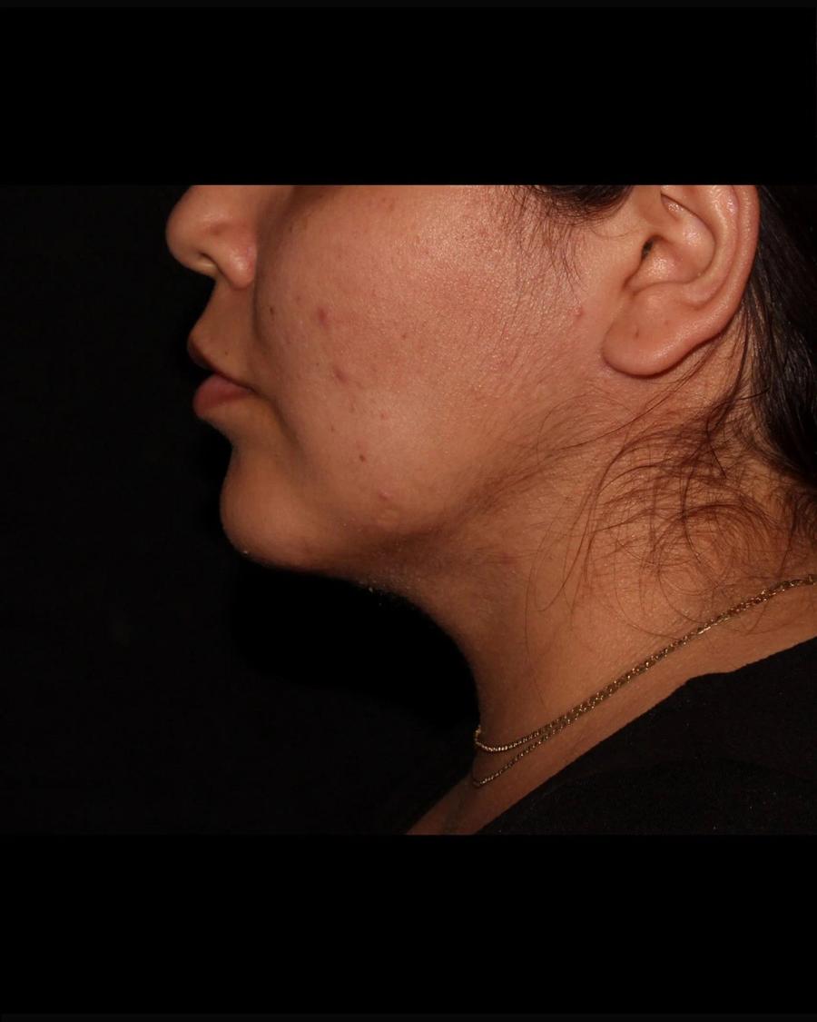 Buccal Fat Pad Removal, Right Profile view, after