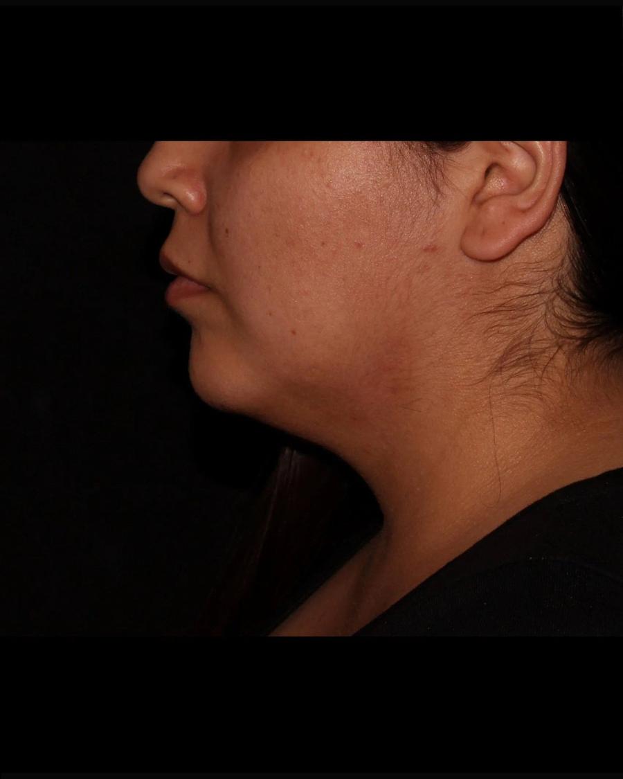 Buccal Fat Pad Removal, Right Profile view, before