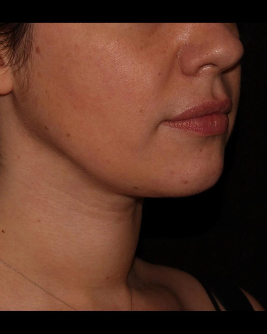 Buccal Fat Pad Removal, Oblique Right view, after