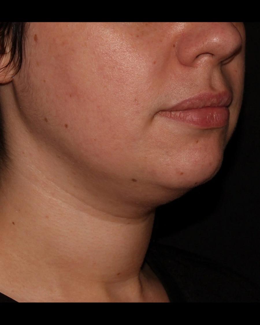 Buccal Fat Pad Removal, Oblique Right view, before