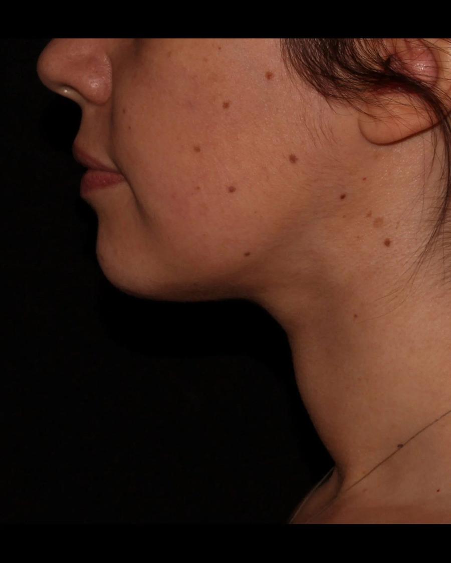 Buccal Fat Pad Removal, Right Profile view, after
