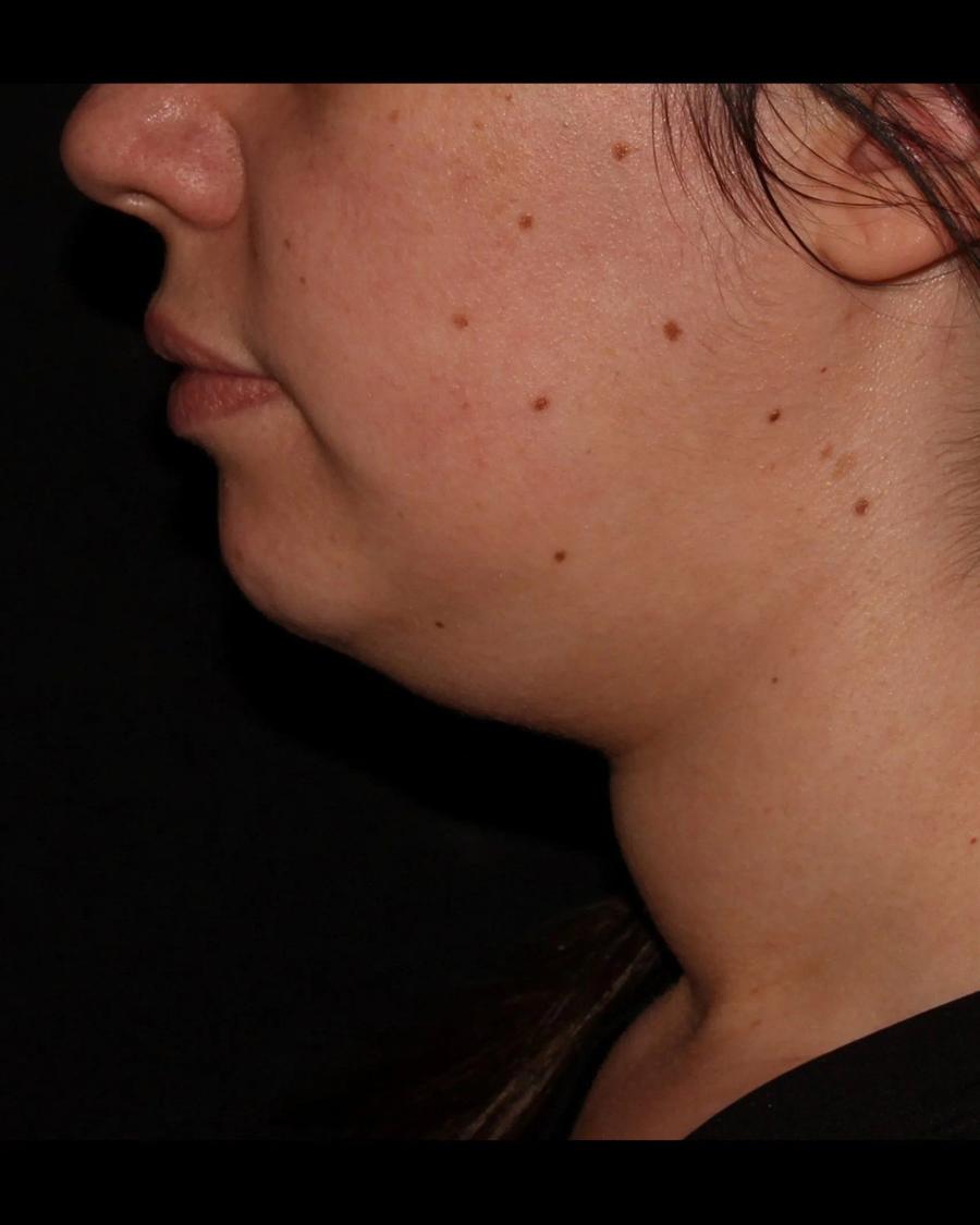 Buccal Fat Pad Removal, Right Profile view, before