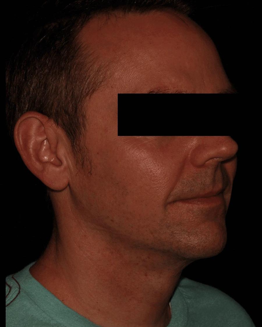 Neck Liposuction w/ Magic Tight after