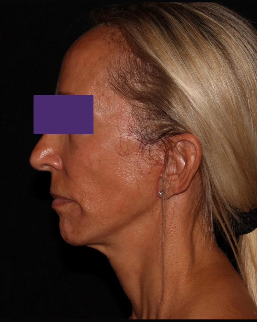 Facelift (neck lift included), Right Profile view, after