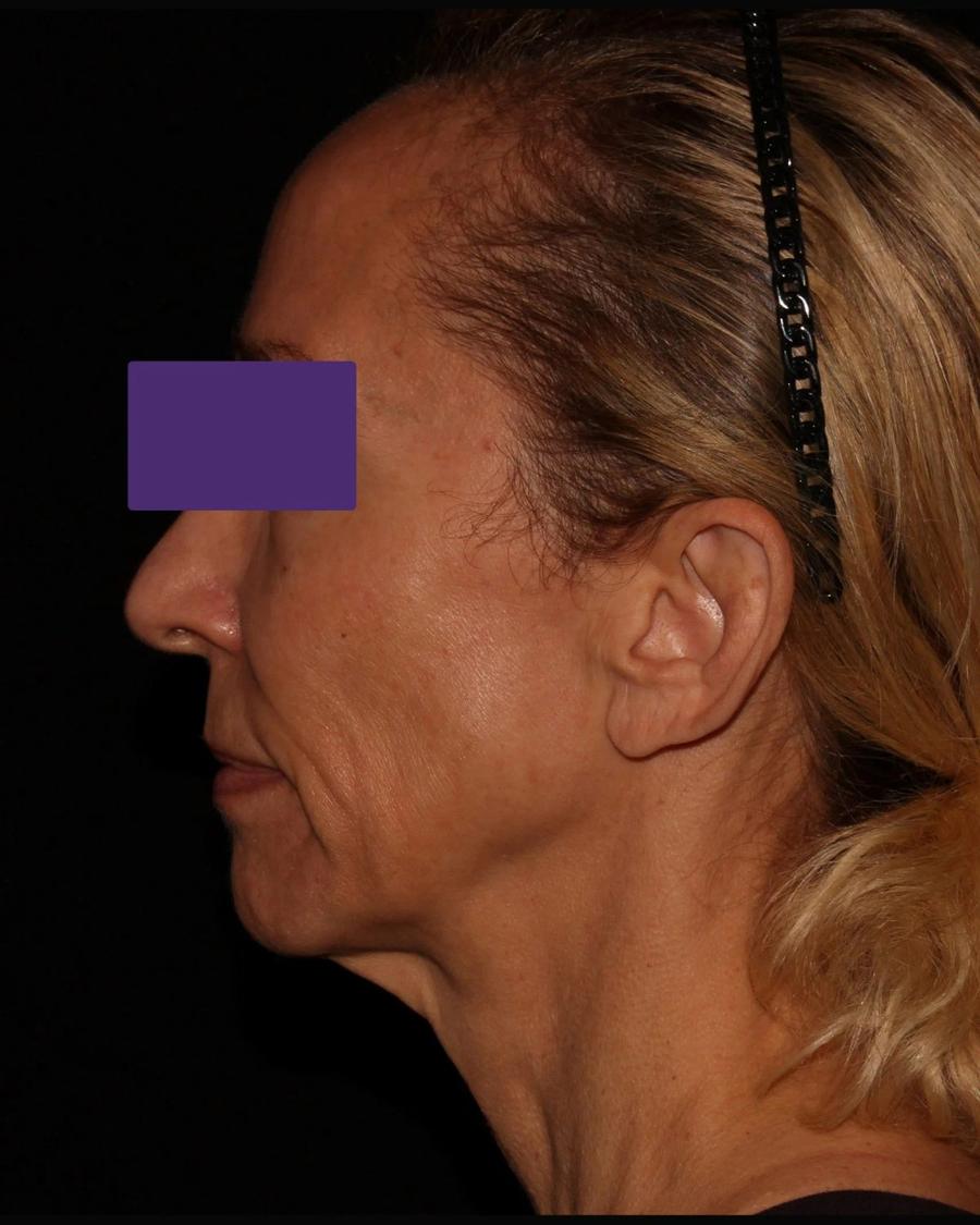 Facelift (neck lift included), Right Profile view, before
