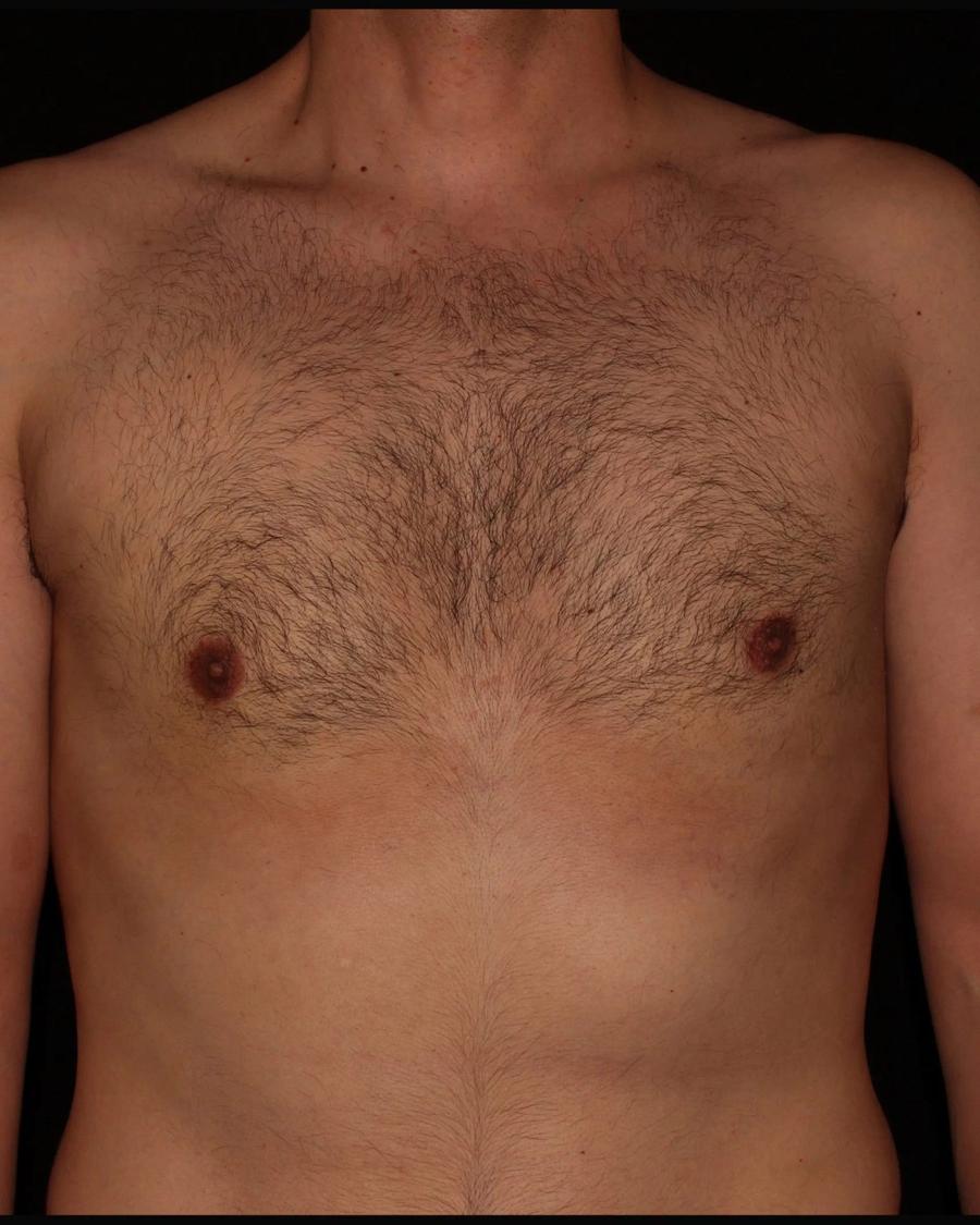 One-Stitch Gynecomastia after