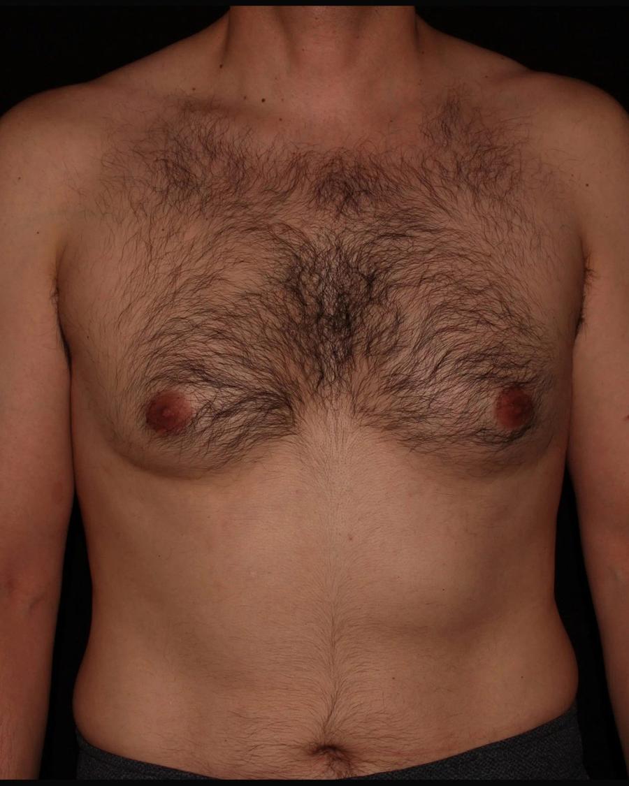 One-Stitch Gynecomastia before