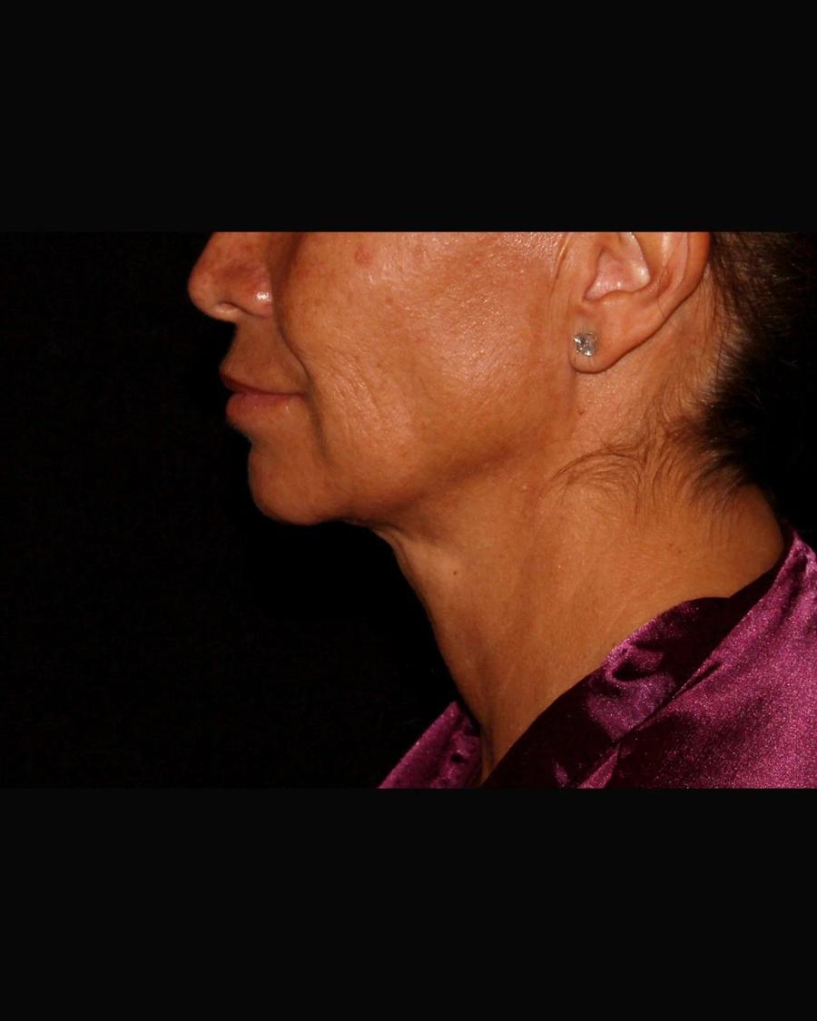 Neck Liposuction w/ Magic Tight, Right Profile view, after