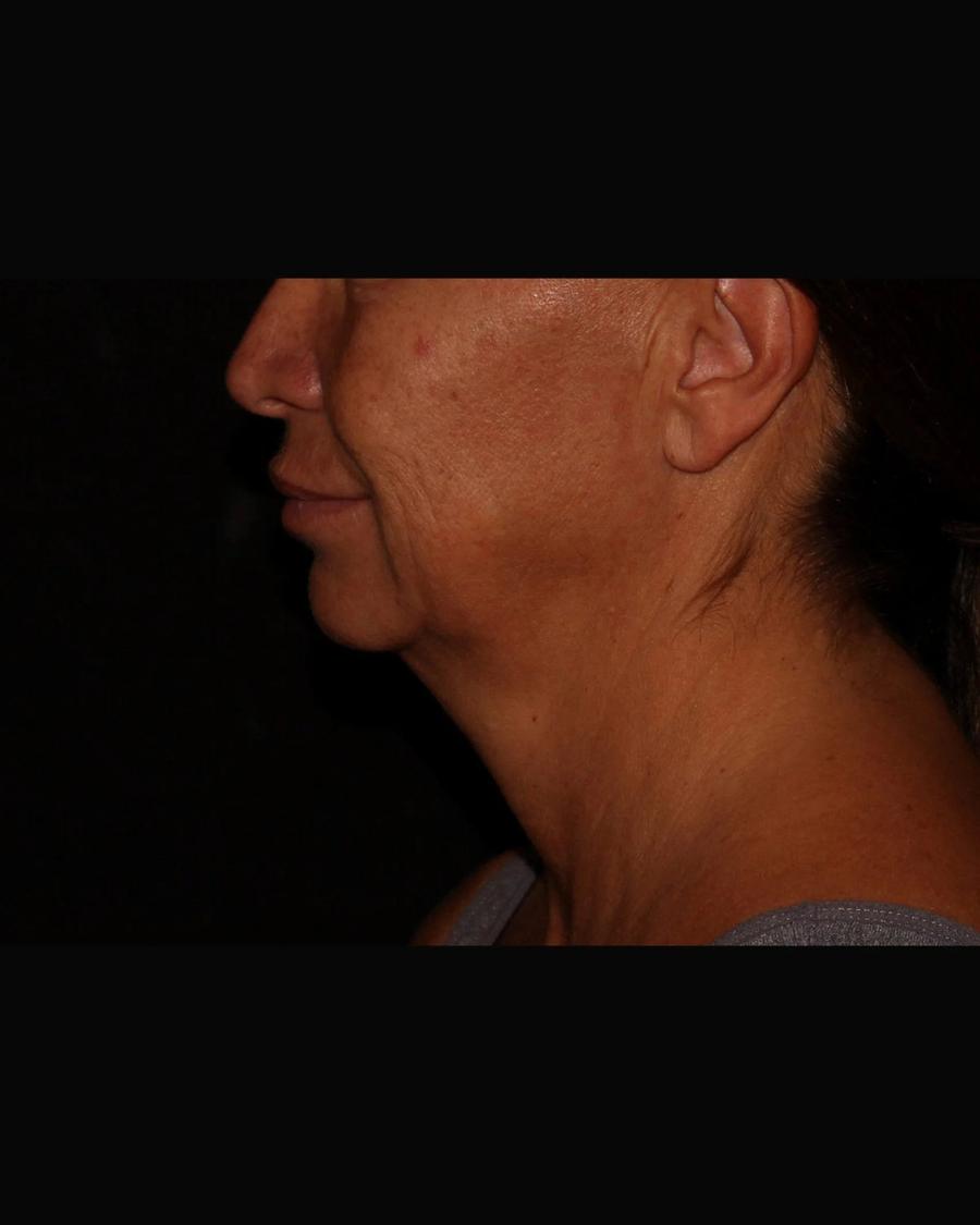 Neck Liposuction w/ Magic Tight, Right Profile view, before