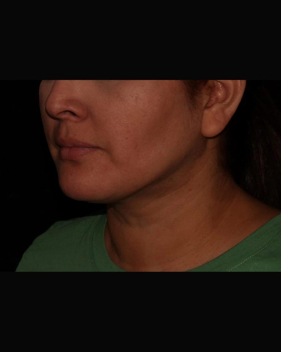 Buccal Fat Pad Removal, Oblique Right view, after