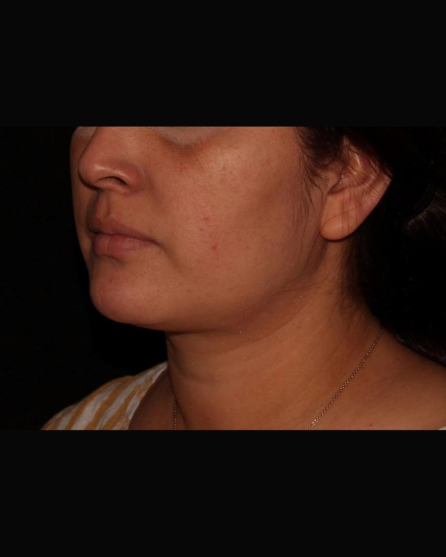 Buccal Fat Pad Removal, Oblique Right view, before