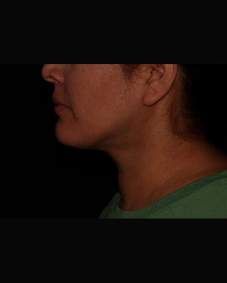 Buccal Fat Pad Removal, Right Profile view, after