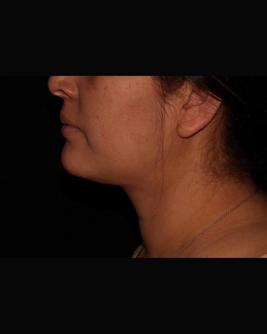 Buccal Fat Pad Removal, Right Profile view, before