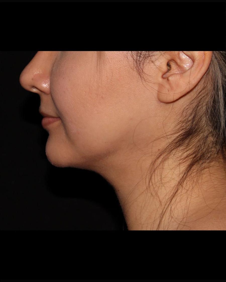 Neck Liposuction w/ Magic Tight, Right Profile view, after