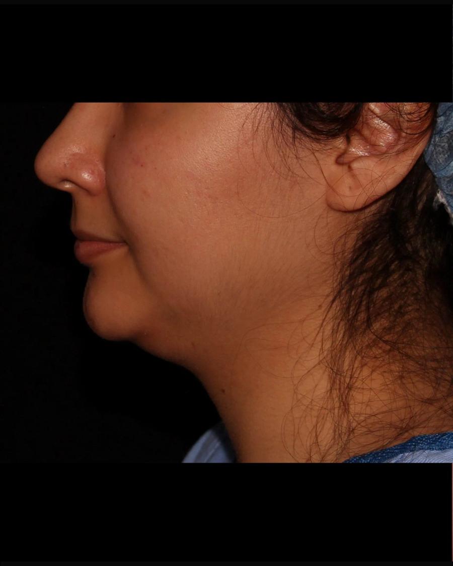 Neck Liposuction w/ Magic Tight, Right Profile view, before