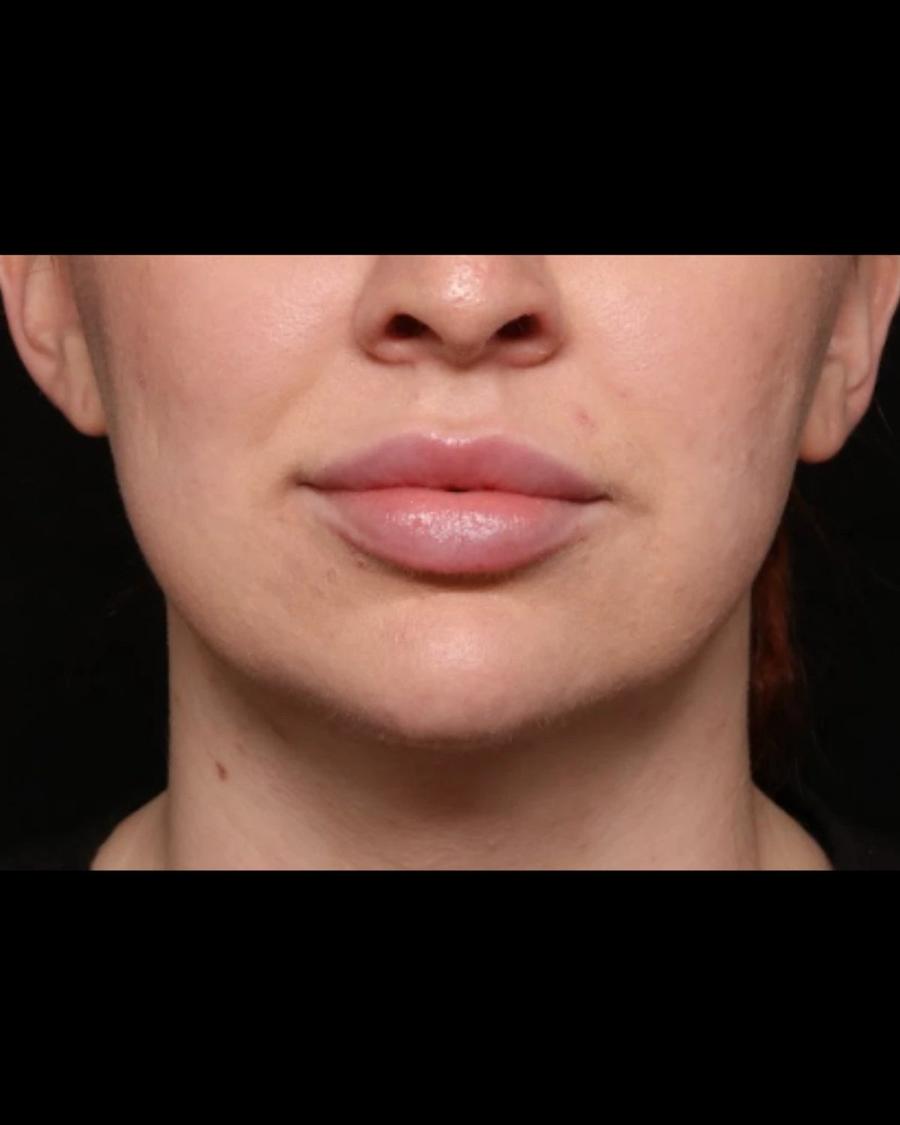 Neck Liposuction w/ Magic Tight after