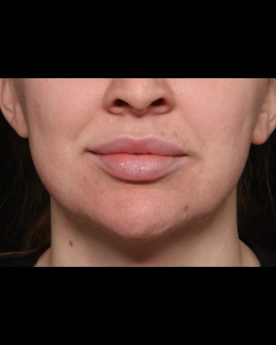 Neck Liposuction w/ Magic Tight before