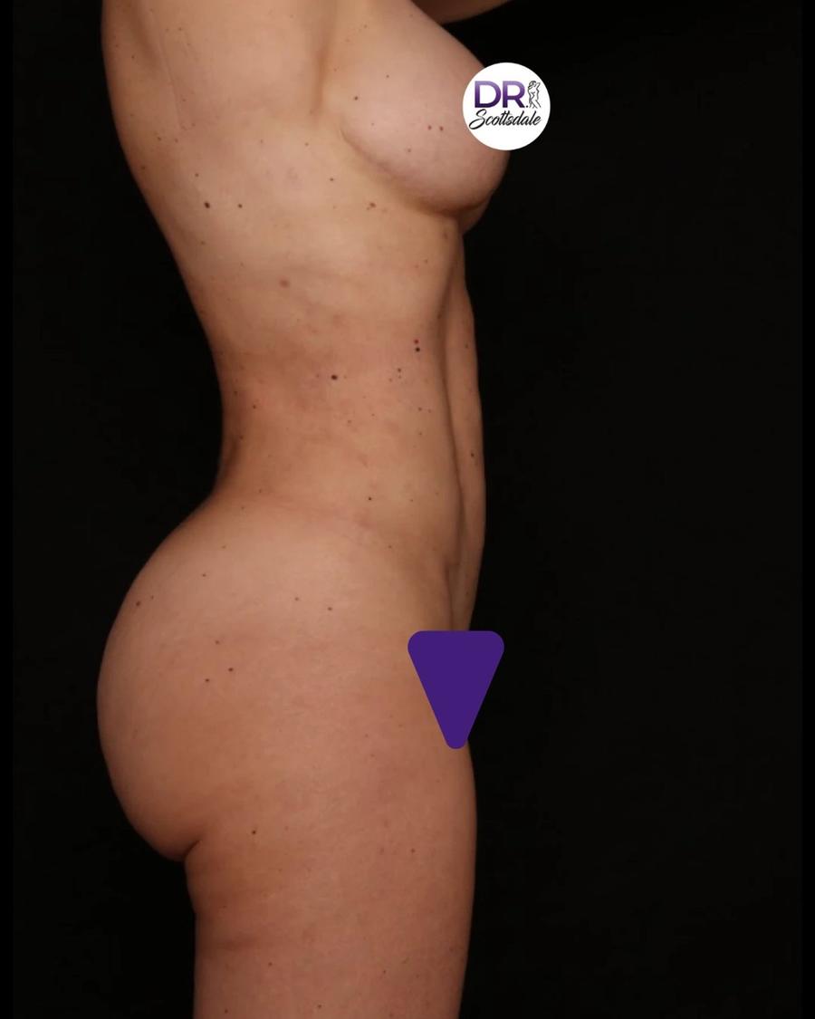 Vaser Lipo 360 (5L Max), Right Profile view, after