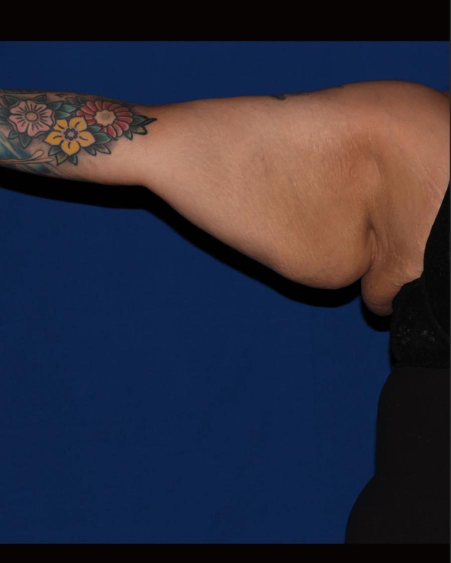 Arm Lift before