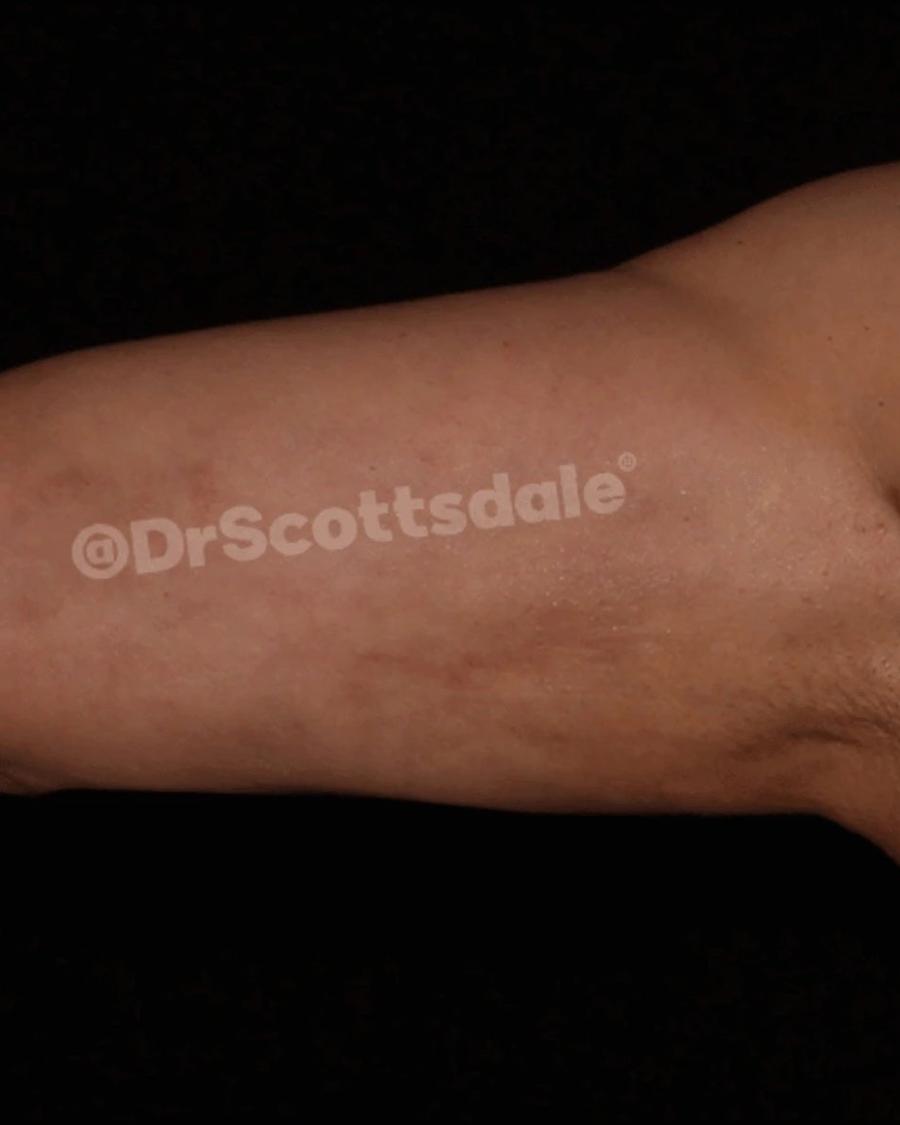 Arm Lift after
