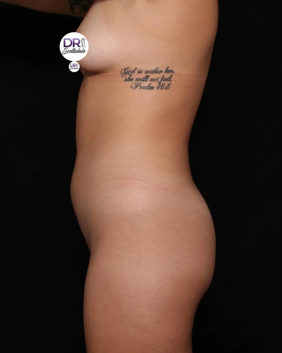Vaser Lipo 360 (5L Max), Right Profile view, before