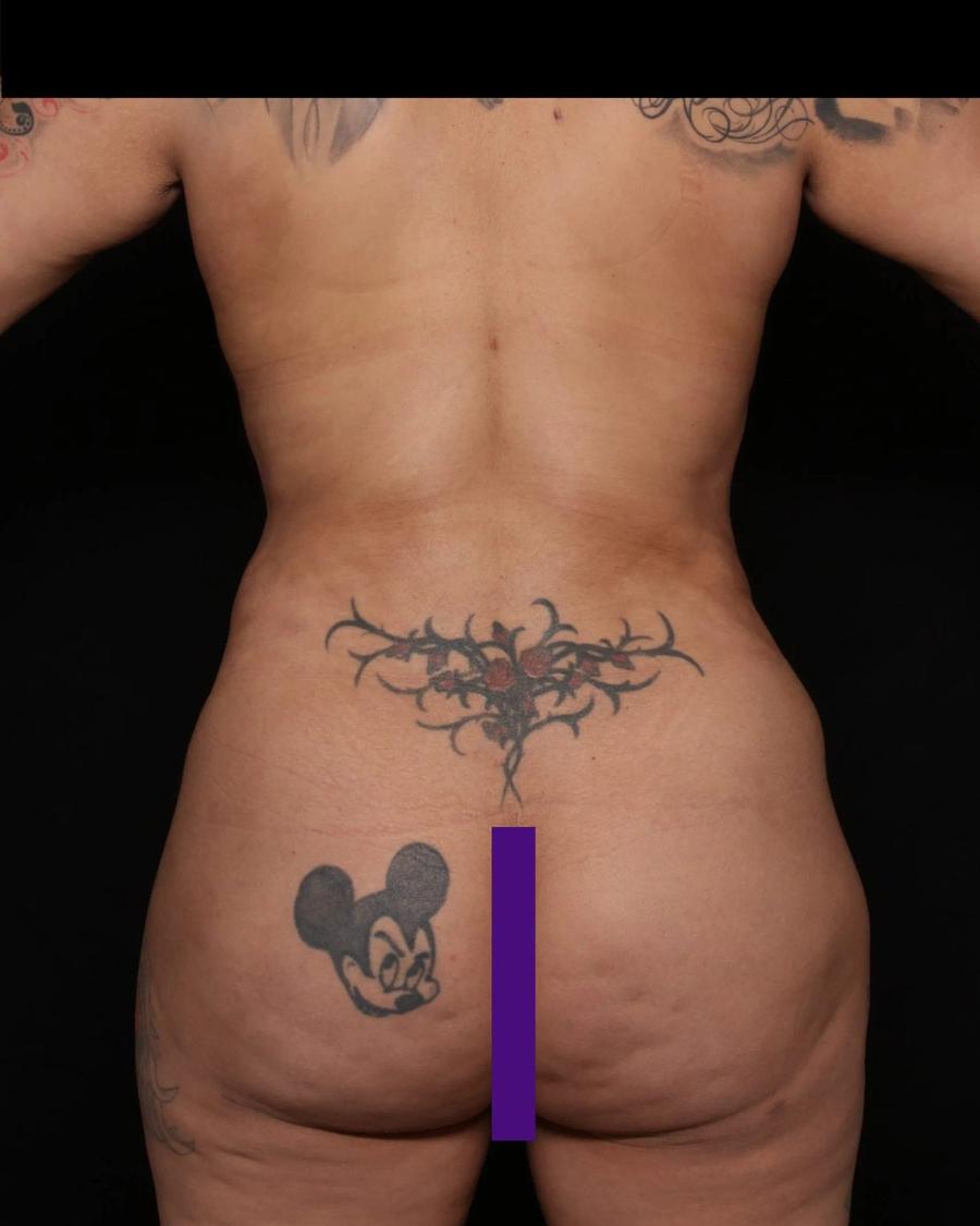 Front Liposuction (5L) (Same As Lipo360), Back view, after