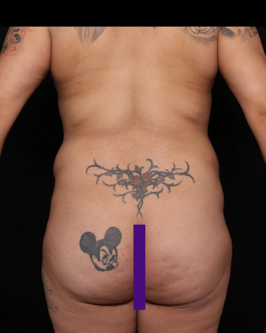 Front Liposuction (5L) (Same As Lipo360), Back view, before