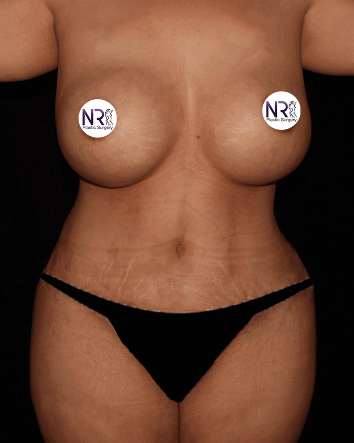Tummy Tuck after