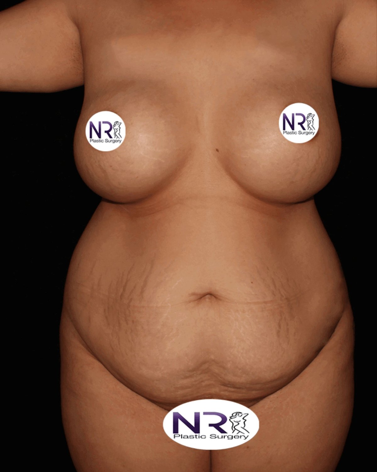 Tummy Tuck before