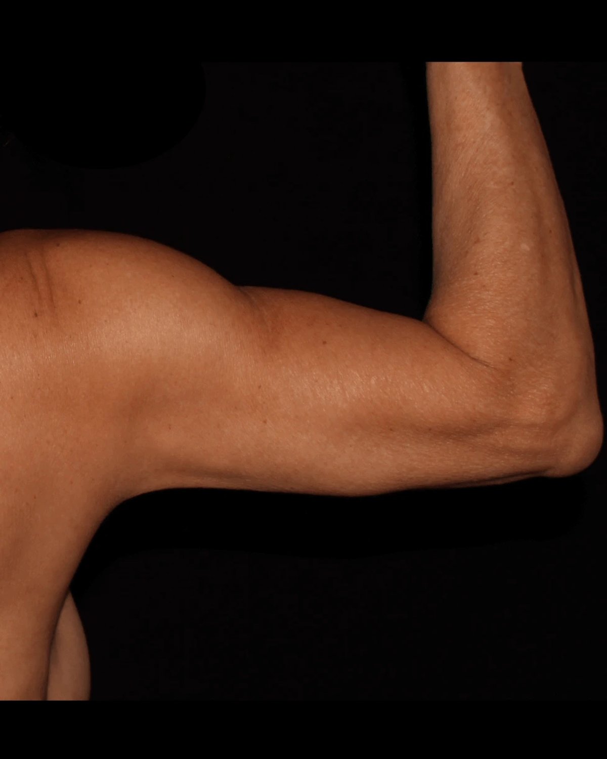 After Arm Lift