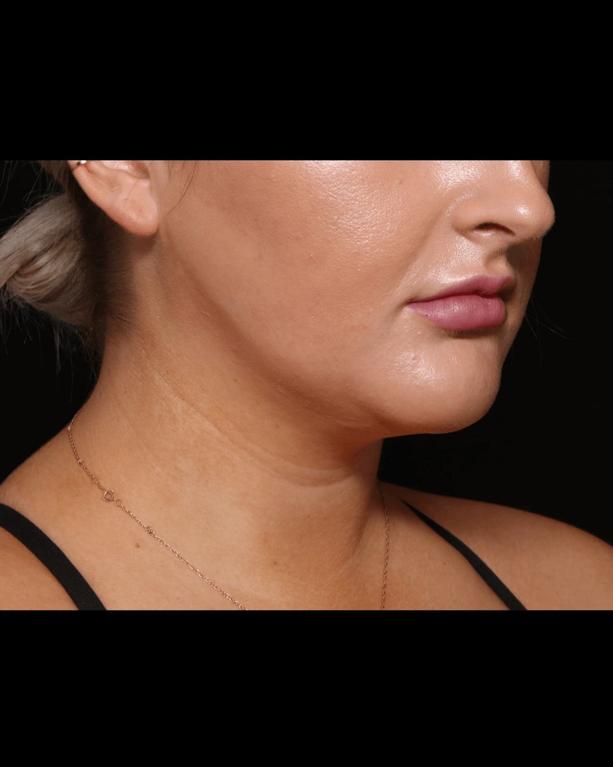 Buccal Fat Pad Removal after
