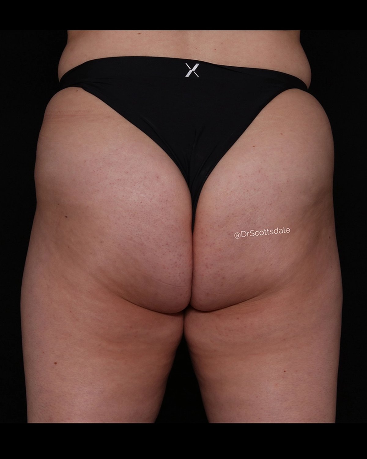 Lipedema after