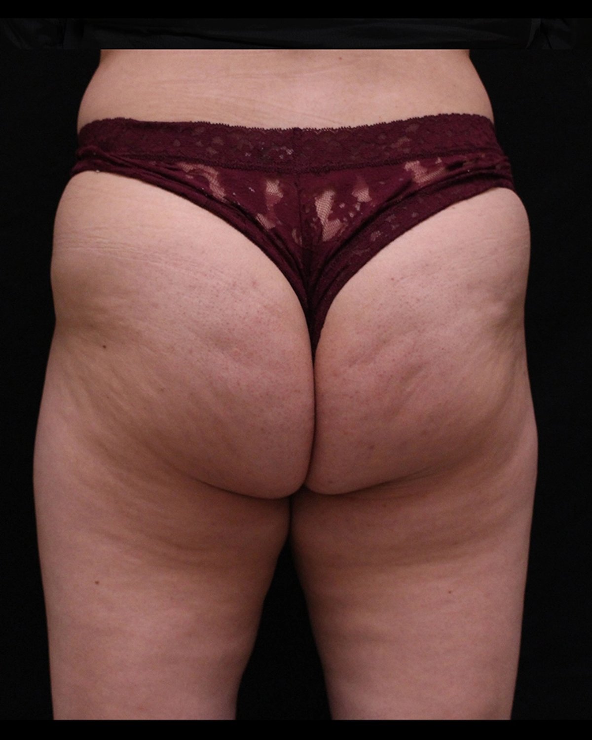 Lipedema before