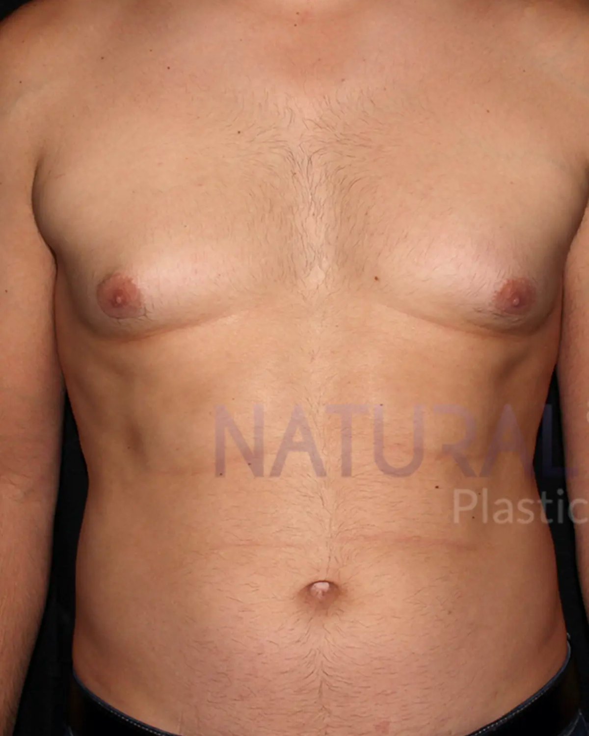 Before One-Stitch Gynecomastia