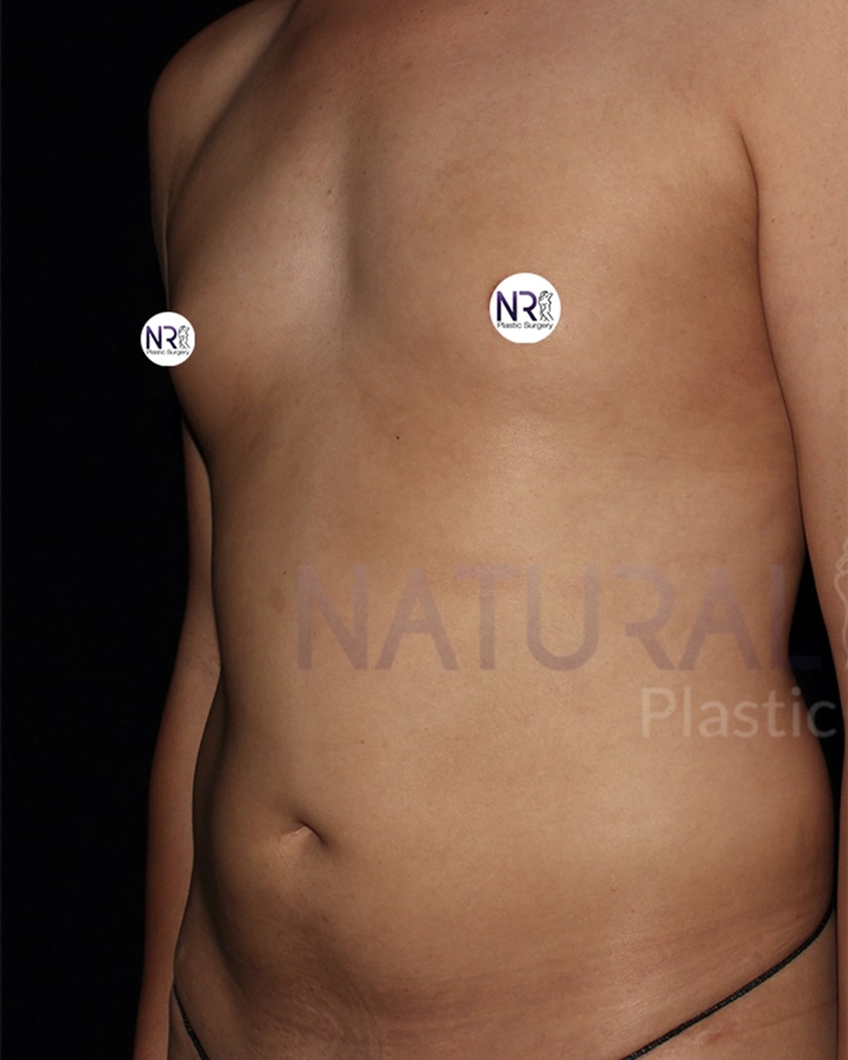 Vaser Lipo 360 (5L Max) before