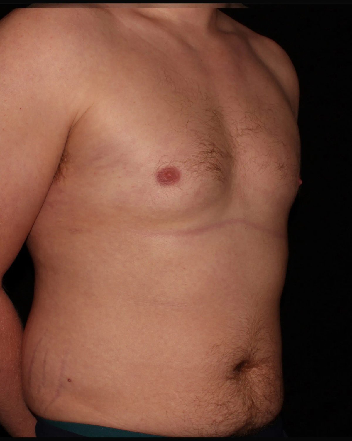 One-Stitch Gynecomastia after