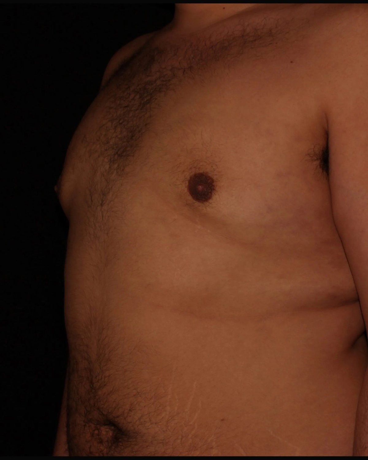 One-Stitch Gynecomastia after