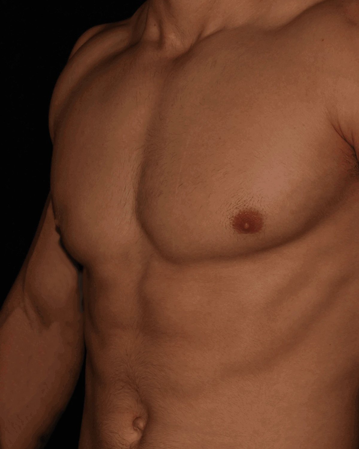 One-Stitch Gynecomastia after