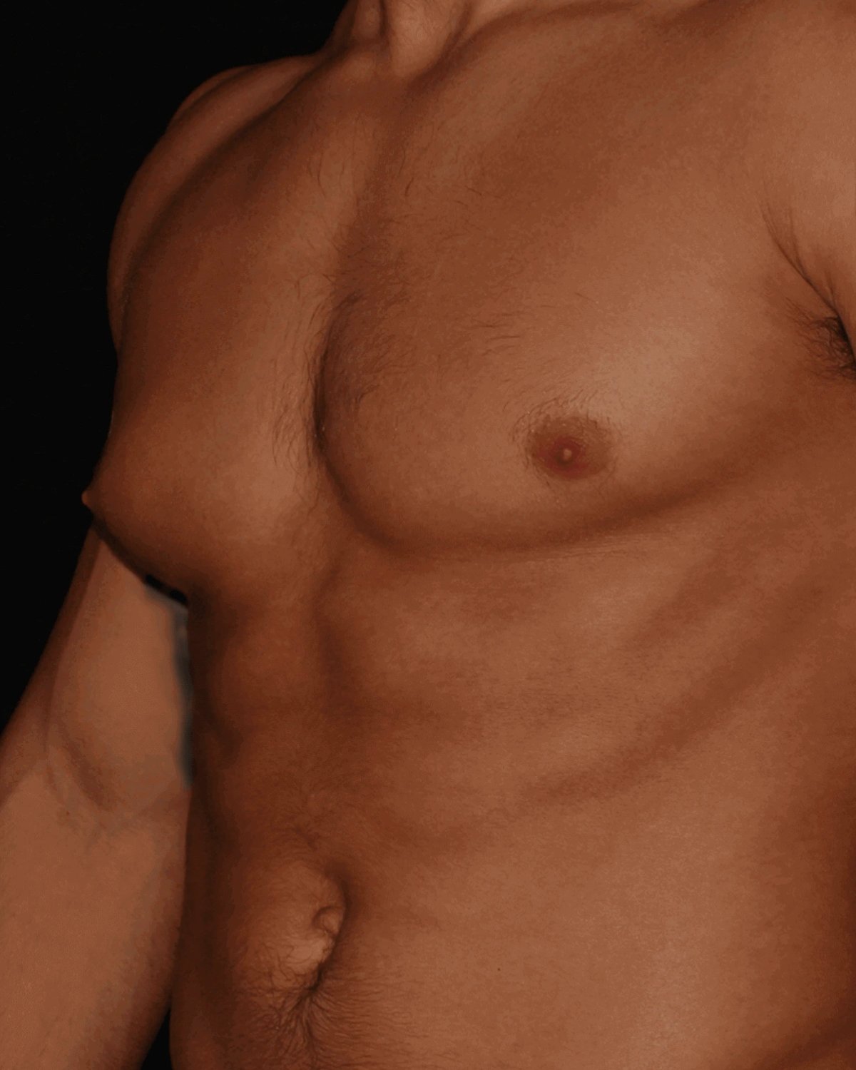 One-Stitch Gynecomastia before