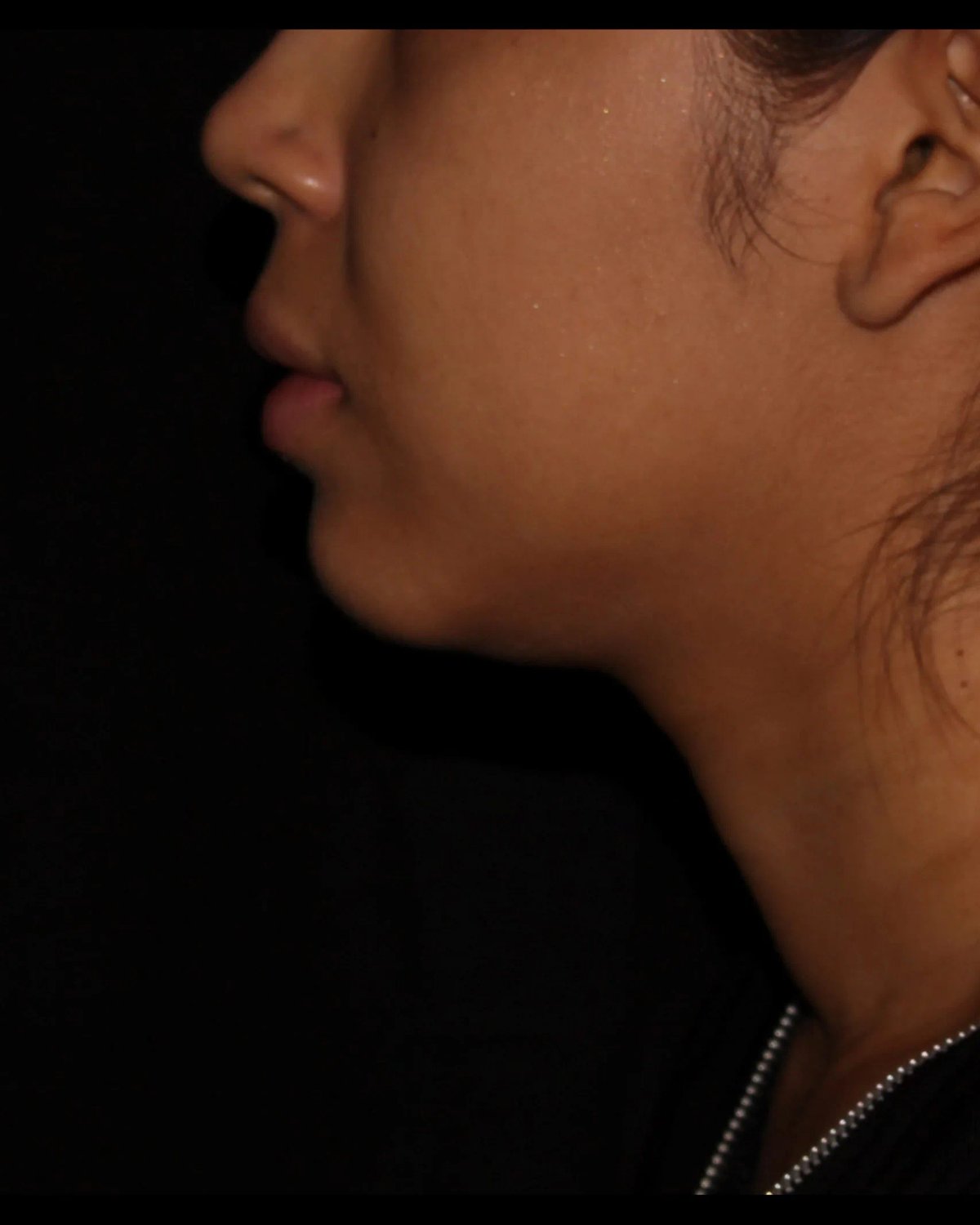 Buccal Fat Pad Removal — Right Profile view, before