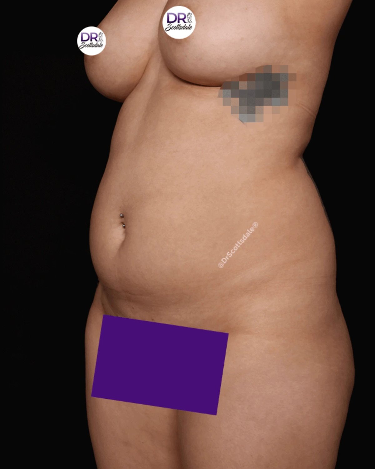 Vaser Lipo 360 (5L Max) before