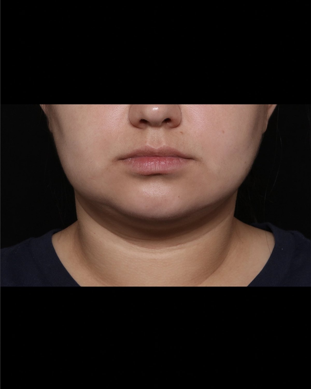 Buccal Fat Pad Removal after
