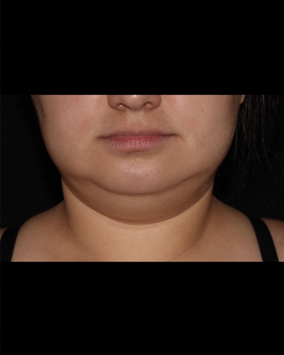 Buccal Fat Pad Removal before