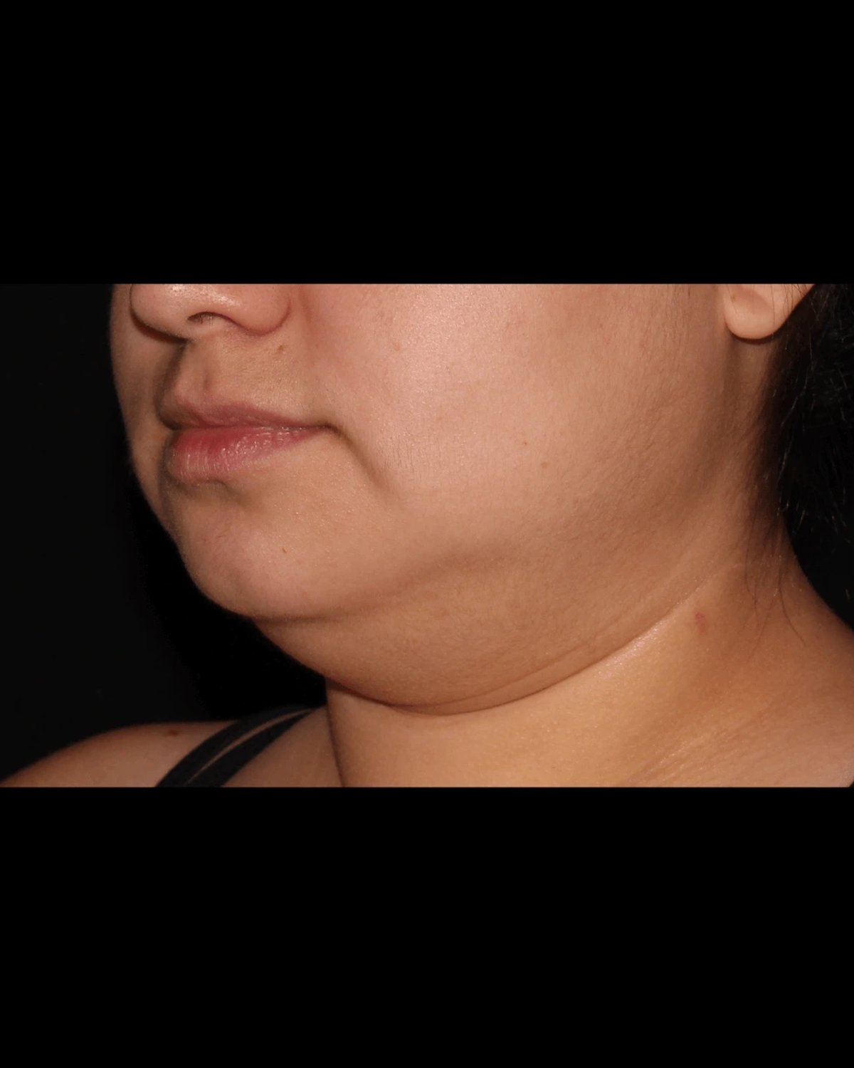 Buccal Fat Pad Removal — Oblique Right view, before