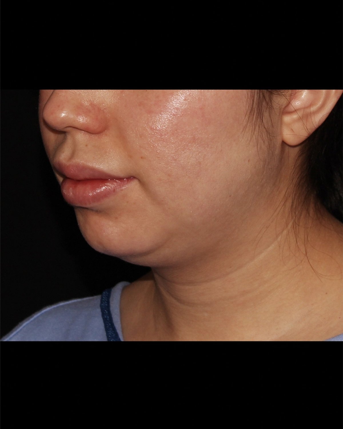 Buccal Fat Pad Removal before