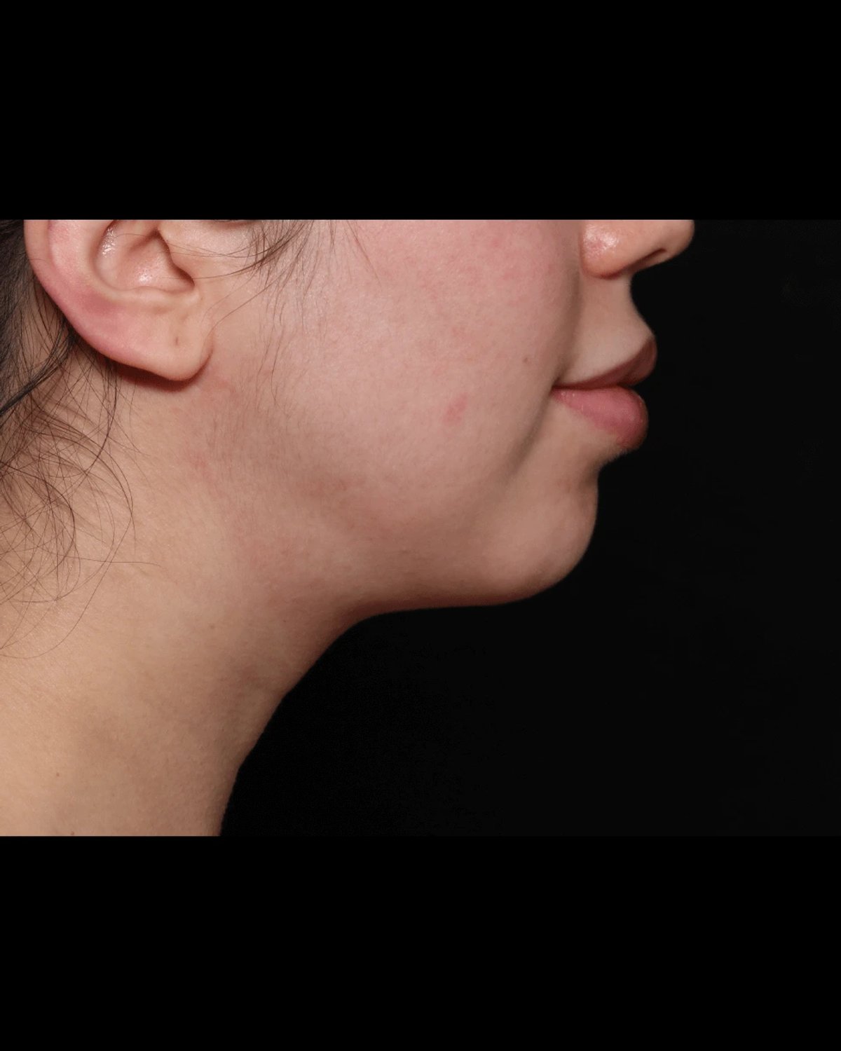 Buccal Fat Pad Removal — Oblique Right view, after