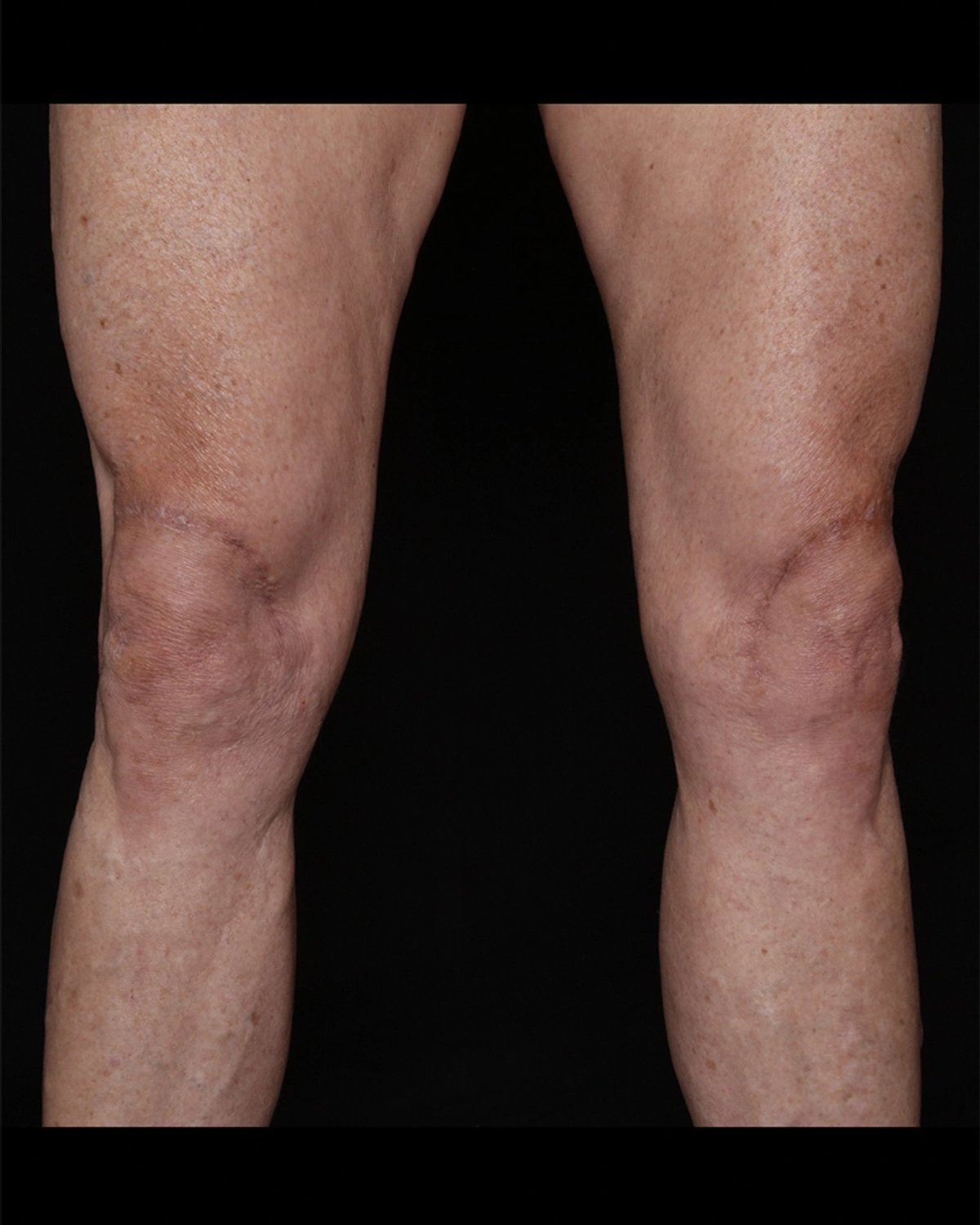 Thigh Lift (Medial) after