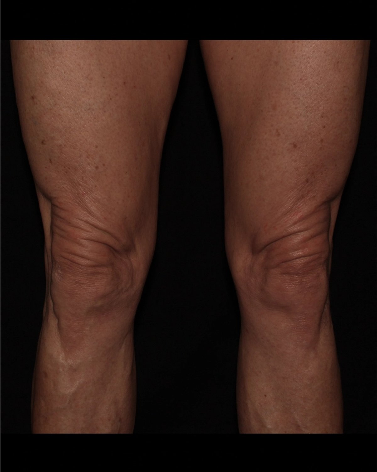 Thigh Lift (Medial) before