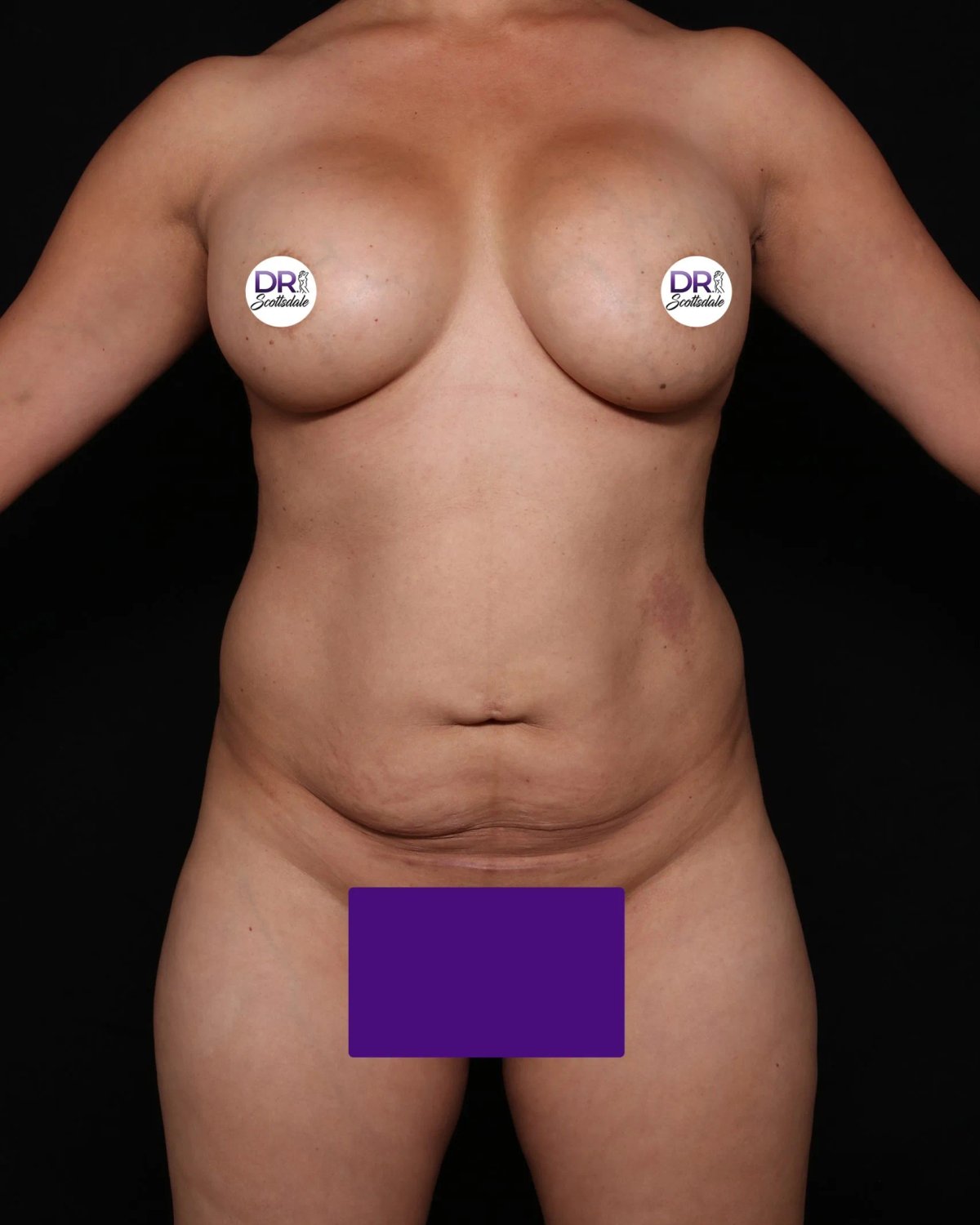 Before Front Liposuction (5L) (Same As Lipo360)